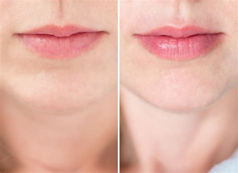 Magical Lip Plumping 101: Everything You Need to Know